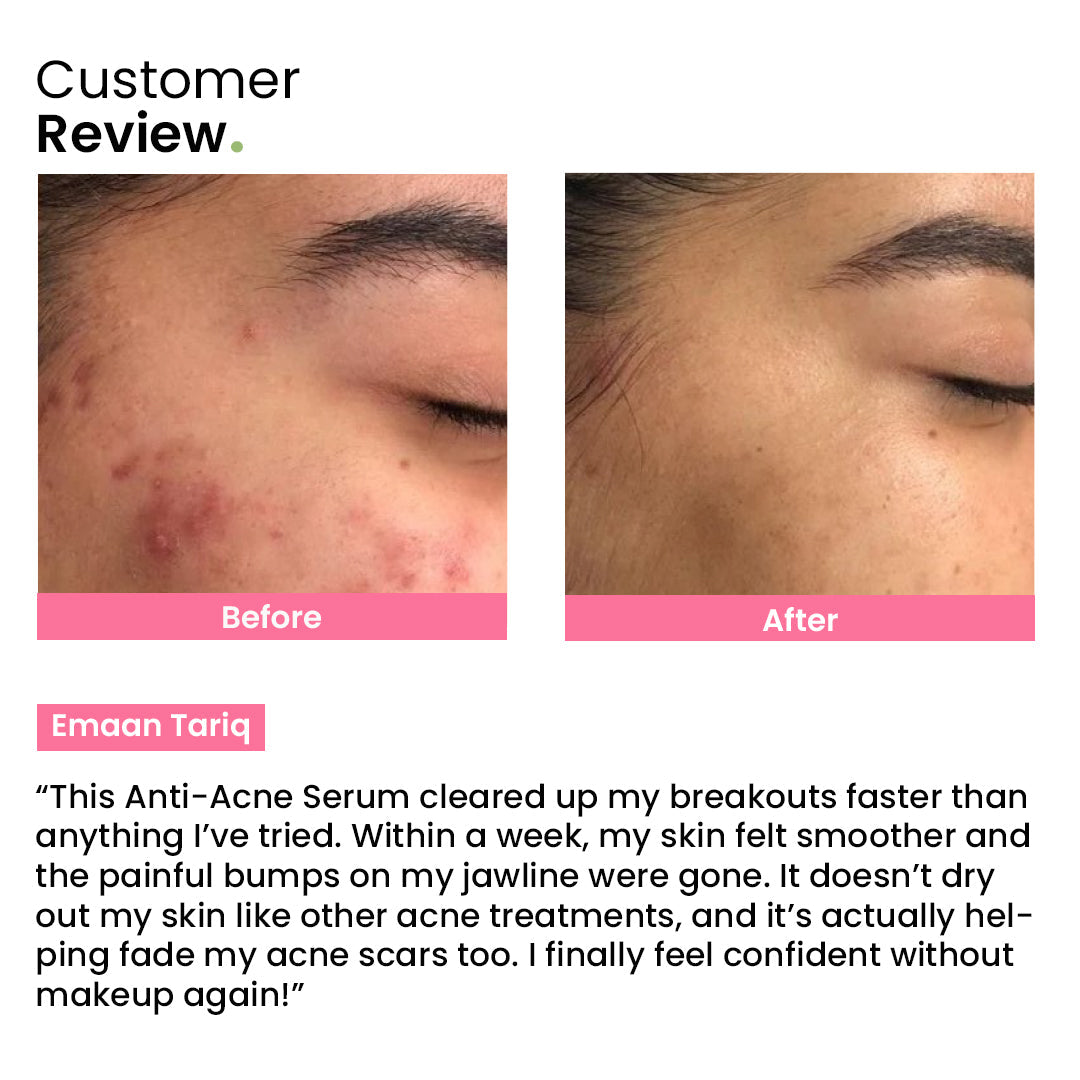 Anti-Acne Serum
